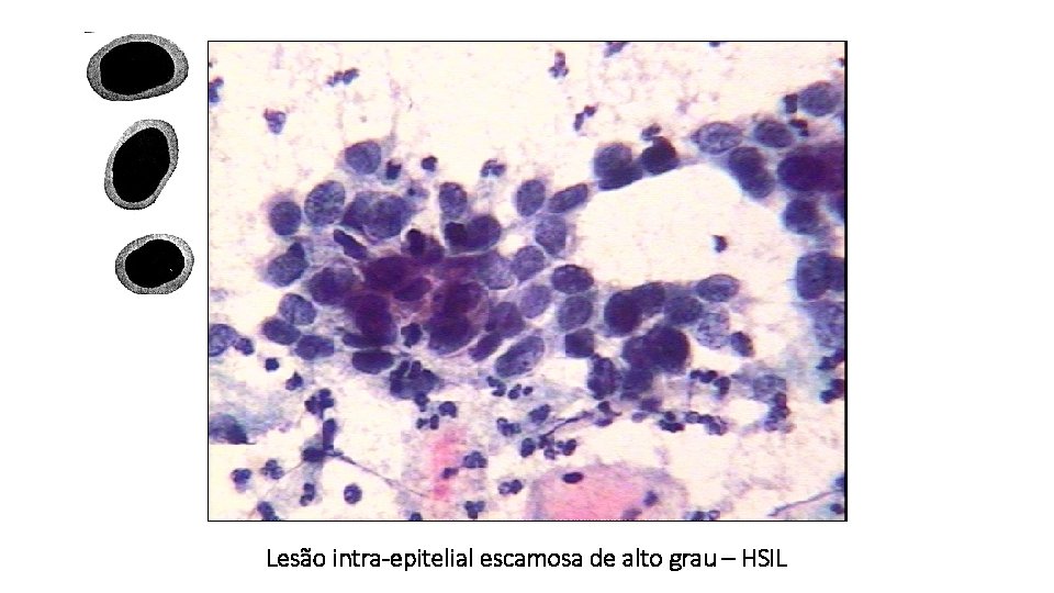 Lesão intra-epitelial escamosa de alto grau – HSIL 