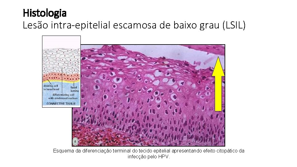 Histologia Lesão intra-epitelial escamosa de baixo grau (LSIL) Esquema da diferenciação terminal do tecido