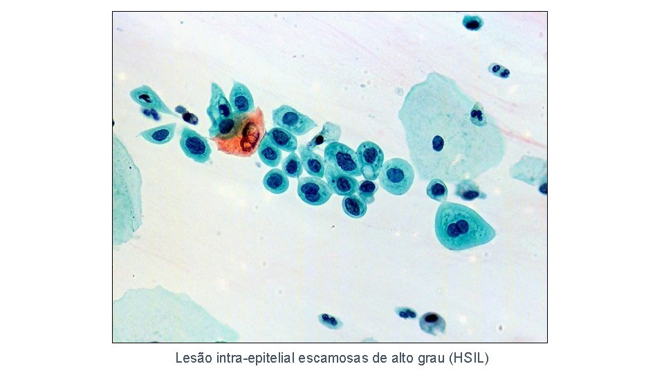 Lesão intra-epitelial escamosas de alto grau (HSIL) 