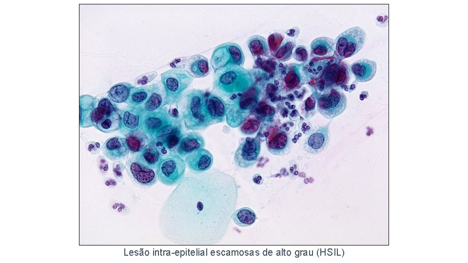 Lesão intra-epitelial escamosas de alto grau (HSIL) 