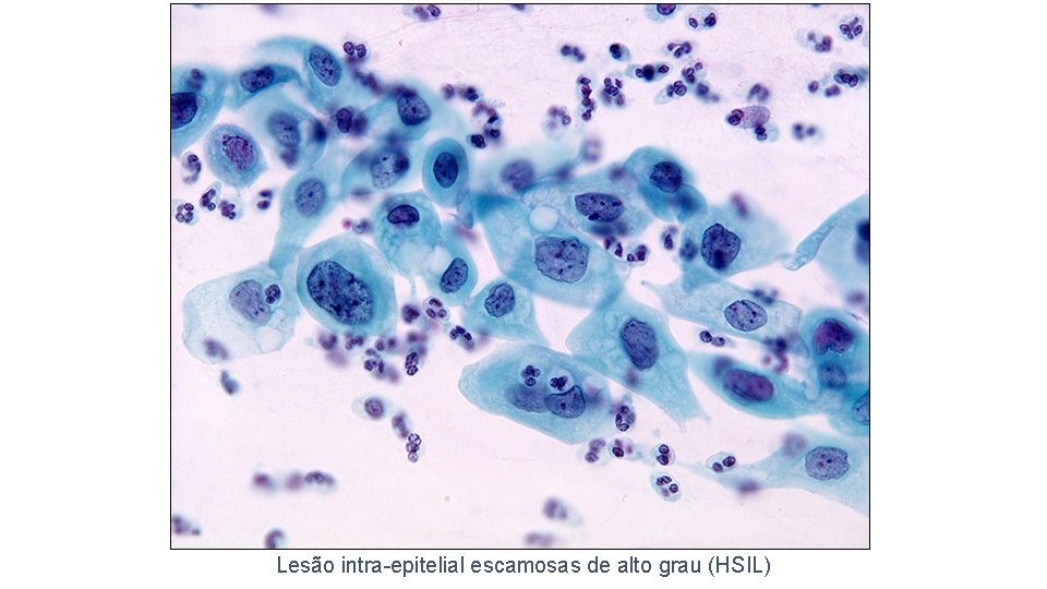 Lesão intra-epitelial escamosas de alto grau (HSIL) 