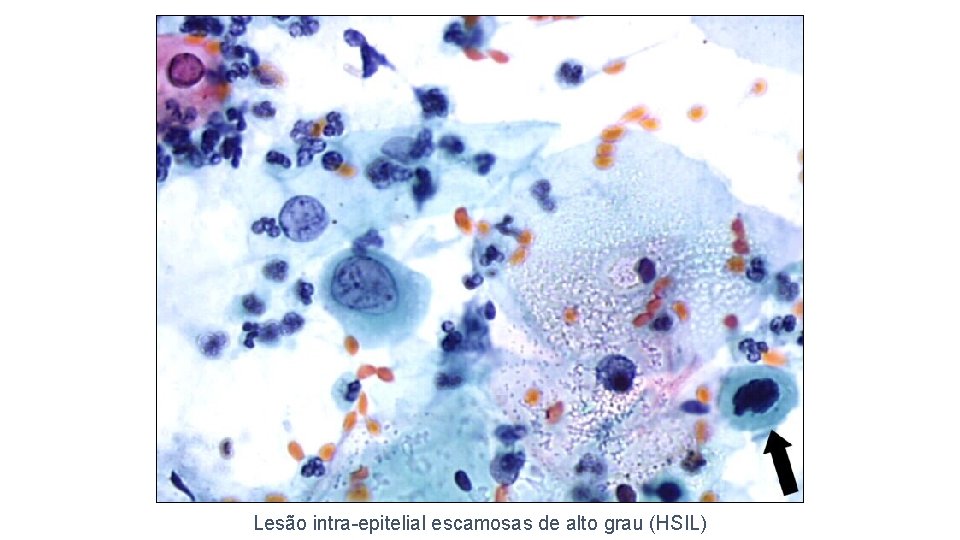 Lesão intra-epitelial escamosas de alto grau (HSIL) 