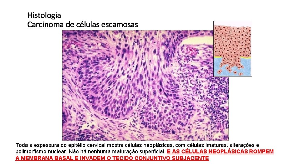 Histologia Carcinoma de células escamosas Histologia - Normal Histologia – CCE Toda a espessura