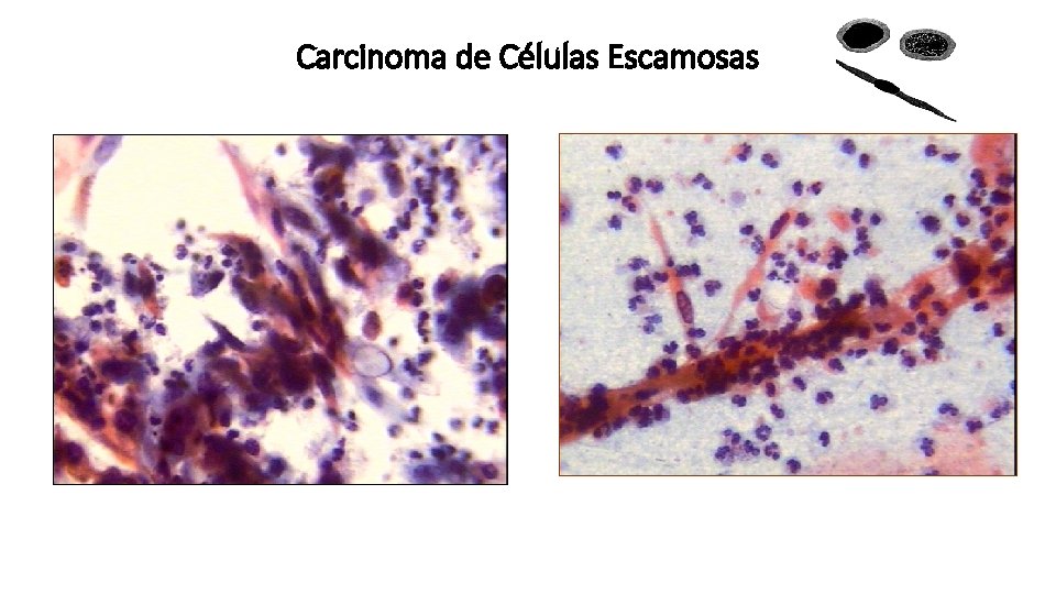 Carcinoma de Células Escamosas 