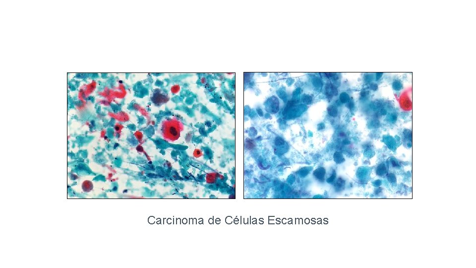 Carcinoma de Células Escamosas 