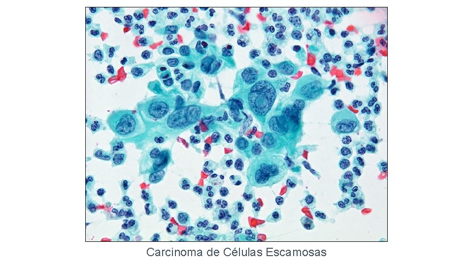 Carcinoma de Células Escamosas 