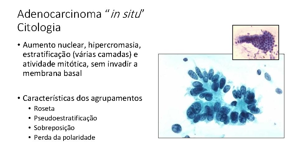 Adenocarcinoma “in situ” Citologia • Aumento nuclear, hipercromasia, estratificação (várias camadas) e atividade mitótica,