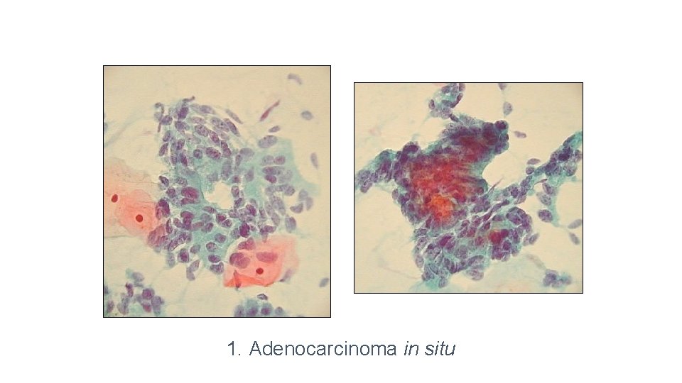 1. Adenocarcinoma in situ 