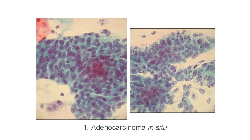 1. Adenocarcinoma in situ 
