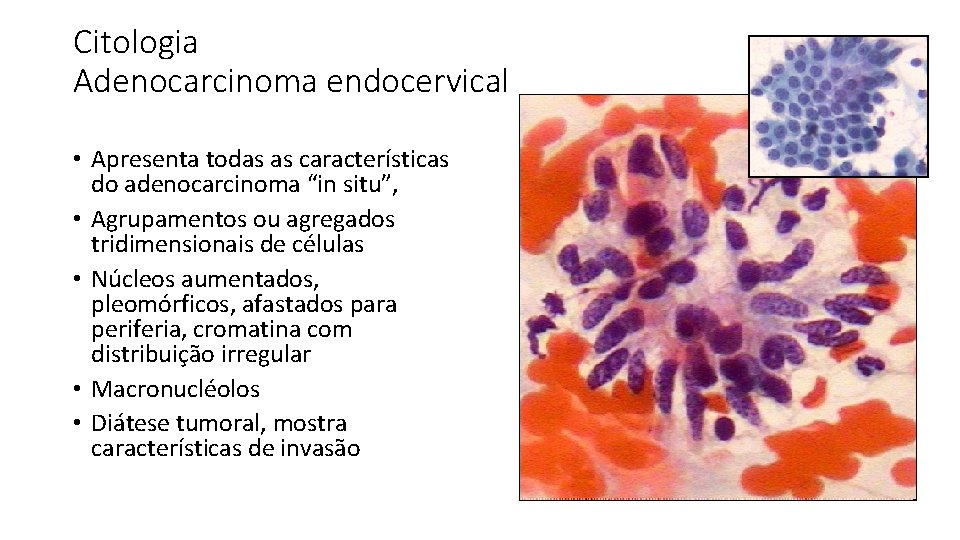 Citologia Adenocarcinoma endocervical • Apresenta todas as características do adenocarcinoma “in situ”, • Agrupamentos