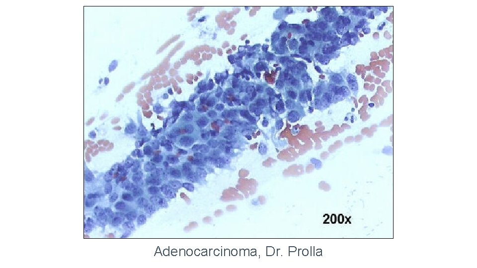 Adenocarcinoma, Dr. Prolla 