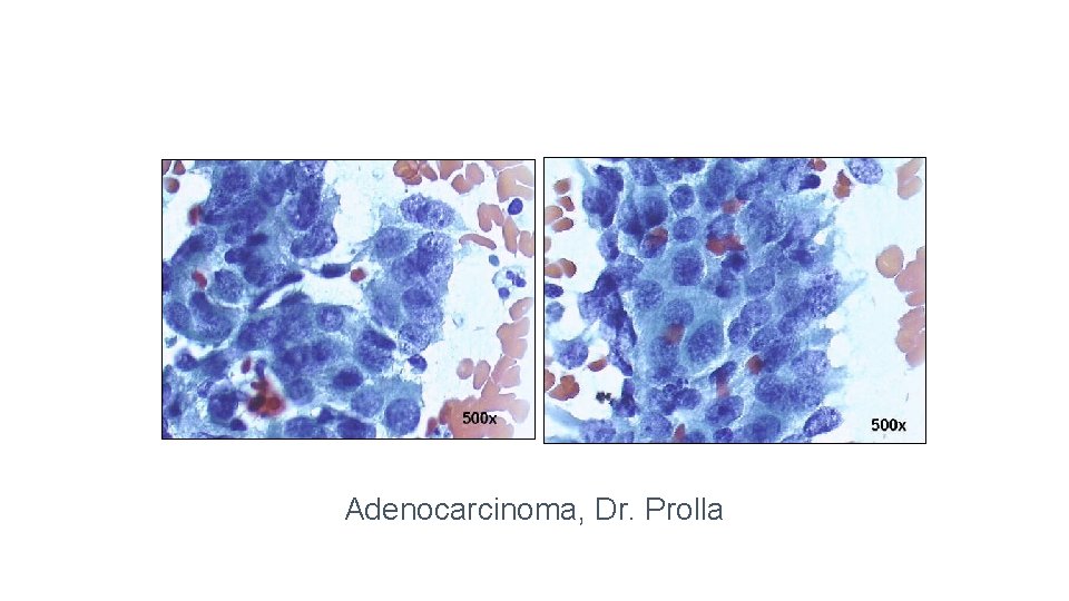 Adenocarcinoma, Dr. Prolla 