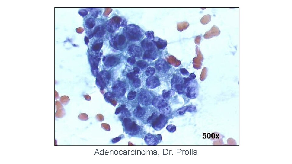 Adenocarcinoma, Dr. Prolla 