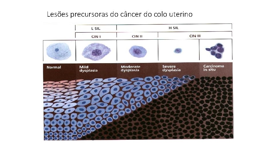 Lesões precursoras do câncer do colo uterino 