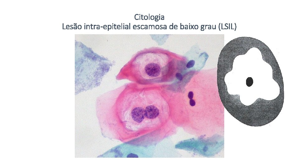 Citologia Lesão intra-epitelial escamosa de baixo grau (LSIL) 