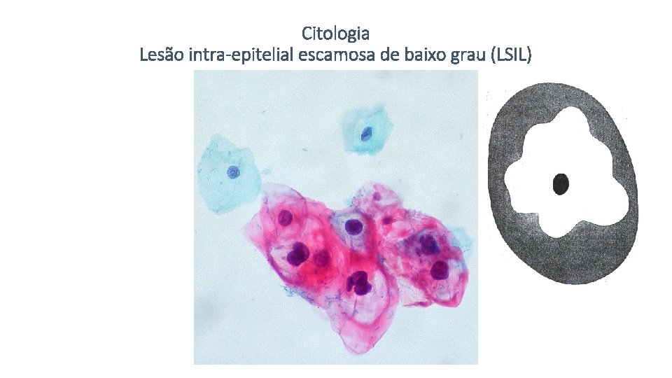 Citologia Lesão intra-epitelial escamosa de baixo grau (LSIL) 