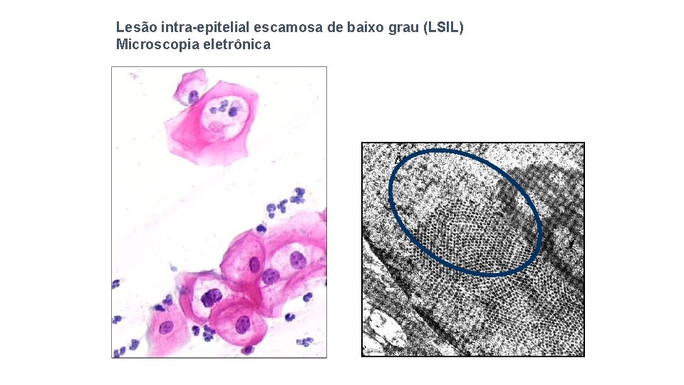 Lesão intra-epitelial escamosa de baixo grau (LSIL) Microscopia eletrônica 