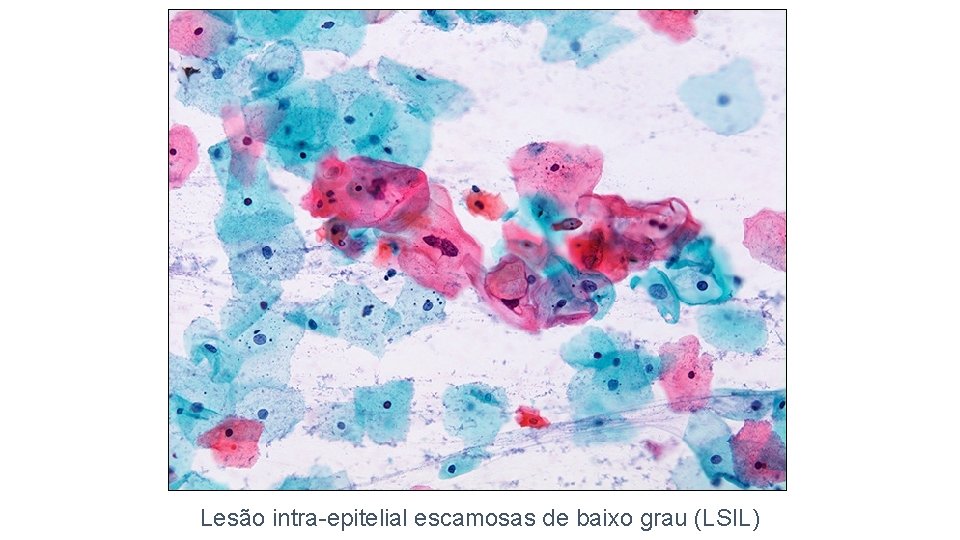 Lesão intra-epitelial escamosas de baixo grau (LSIL) 