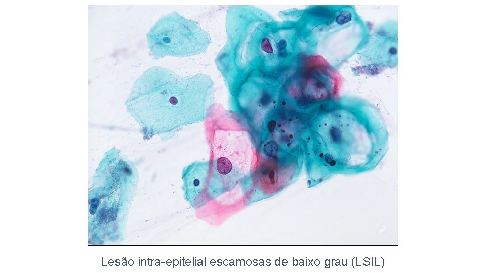 Lesão intra-epitelial escamosas de baixo grau (LSIL) 