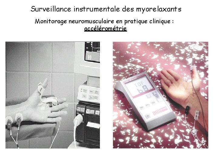 Surveillance instrumentale des myorelaxants Monitorage neuromusculaire en pratique clinique : accélérométrie 