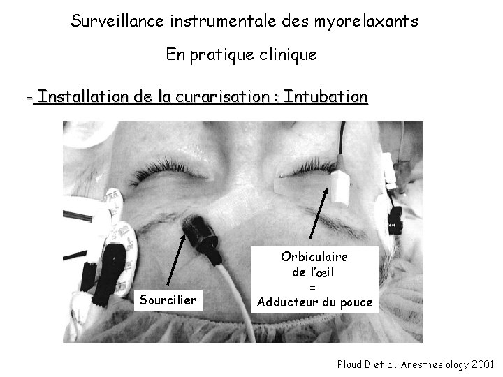 Surveillance instrumentale des myorelaxants En pratique clinique - Installation de la curarisation : Intubation
