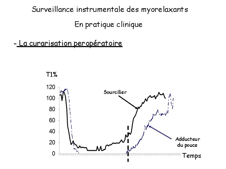 Surveillance instrumentale des myorelaxants En pratique clinique - La curarisation peropératoire T 1% Sourcilier