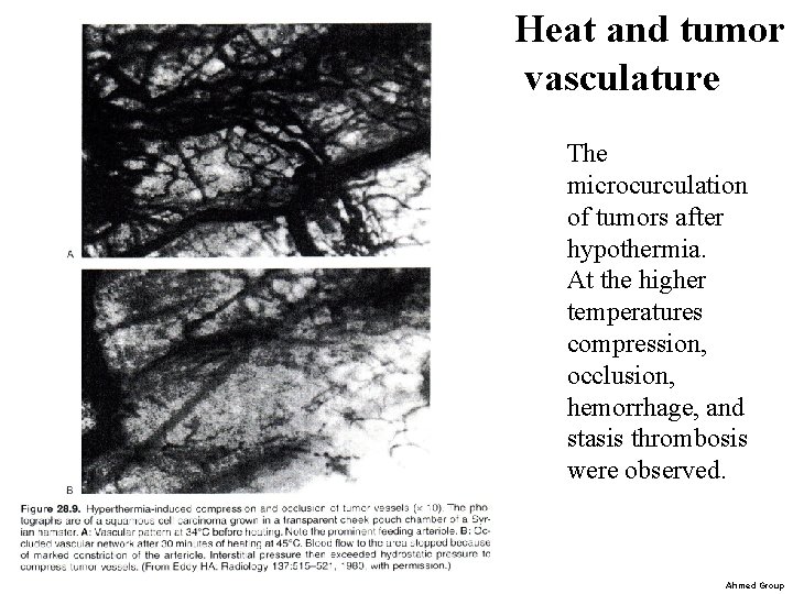Heat and tumor vasculature The microcurculation of tumors after hypothermia. At the higher temperatures