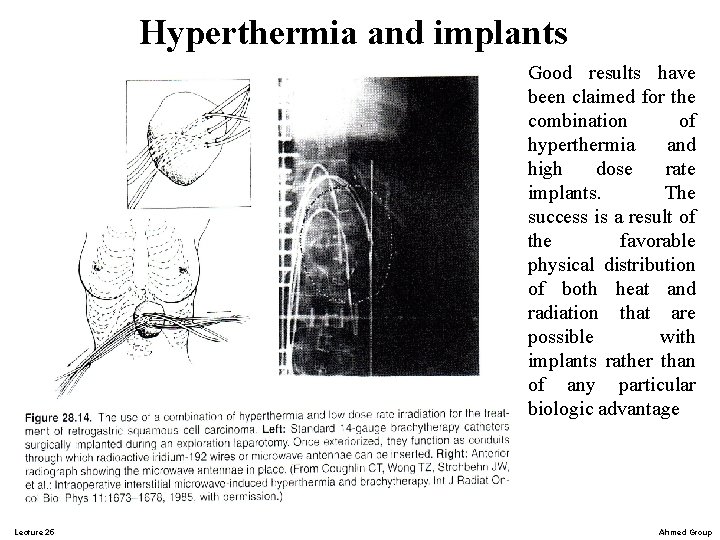 Hyperthermia and implants Good results have been claimed for the combination of hyperthermia and