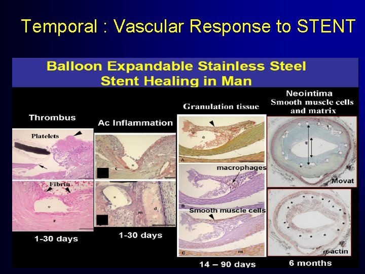 Temporal : Vascular Response to STENT Temporal : Vascular Response to STENT