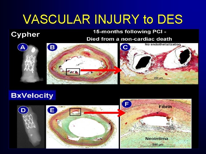 VASCULAR INJURY to DES VASCULAR INJURY to DES