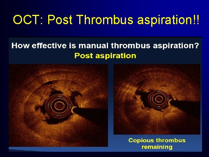 OCT: Post Thrombus aspiration!! OCT: Post Thrombus aspiration!!