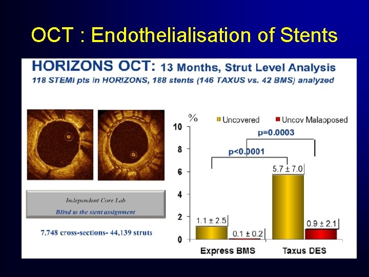 OCT : Endothelialisation of Stents OCT : Endothelialisation of Stents