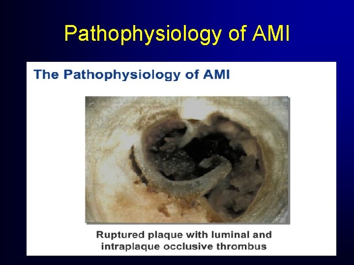 Pathophysiology of AMI Pathophysiology of AMI
