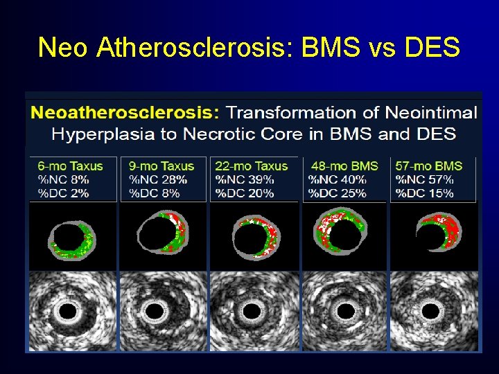 Neo Atherosclerosis: BMS vs DES Neo Atherosclerosis: BMS vs DES