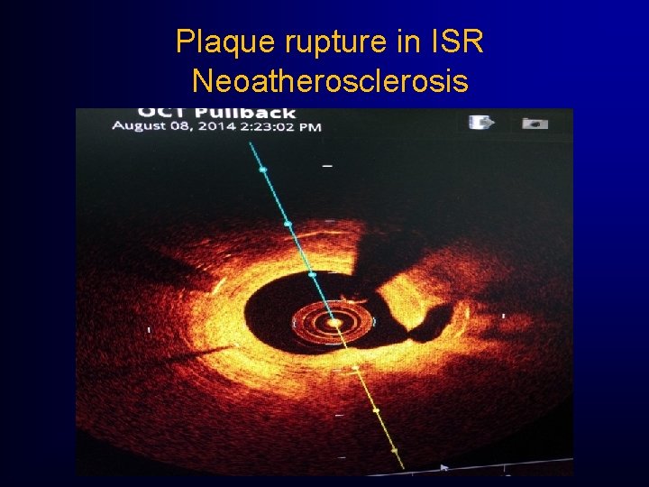 Plaque rupture in ISR Neoatherosclerosis Plaque rupture in ISR Neoatherosclerosis
