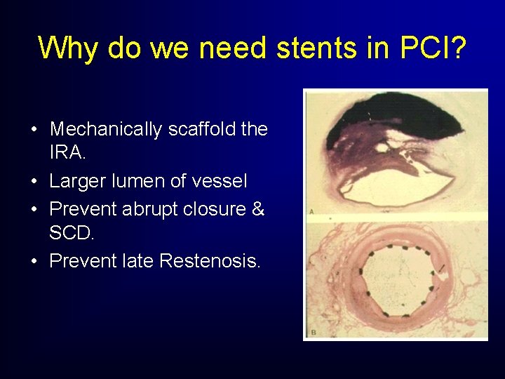 Why do we need stents in PCI? • Mechanically scaffold the IRA. • Larger Why do we need stents in PCI? • Mechanically scaffold the IRA. • Larger
