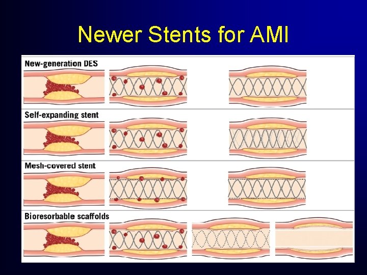 Newer Stents for AMI Newer Stents for AMI