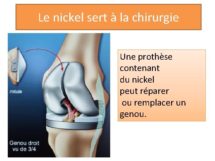 Le nickel sert à la chirurgie Une prothèse contenant du nickel peut réparer ou