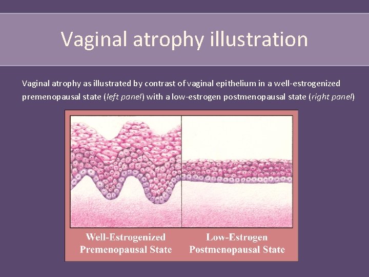 Vaginal atrophy illustration Vaginal atrophy as illustrated by contrast of vaginal epithelium in a