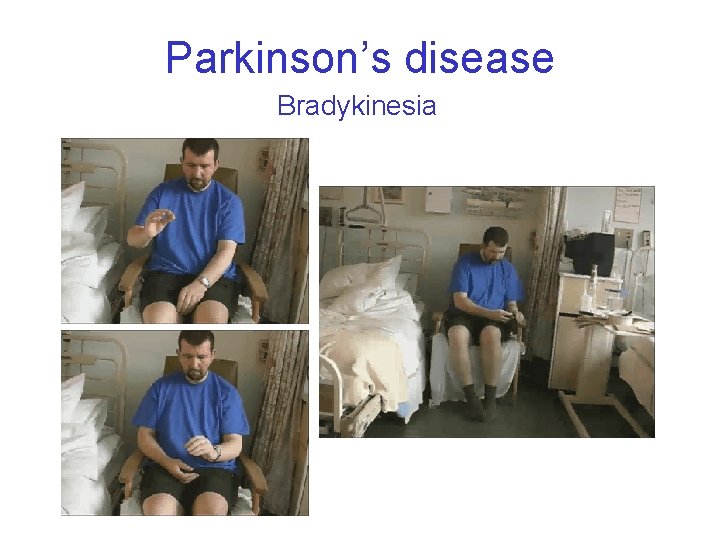 Parkinson’s disease Bradykinesia 