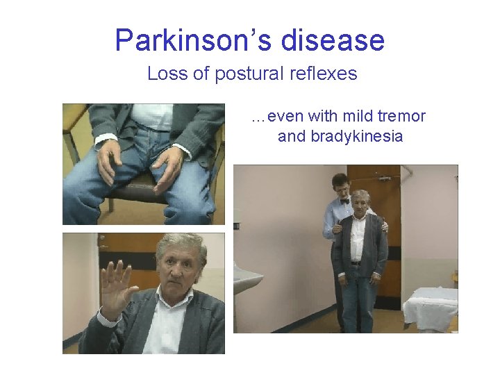 Parkinson’s disease Loss of postural reflexes …even with mild tremor and bradykinesia 