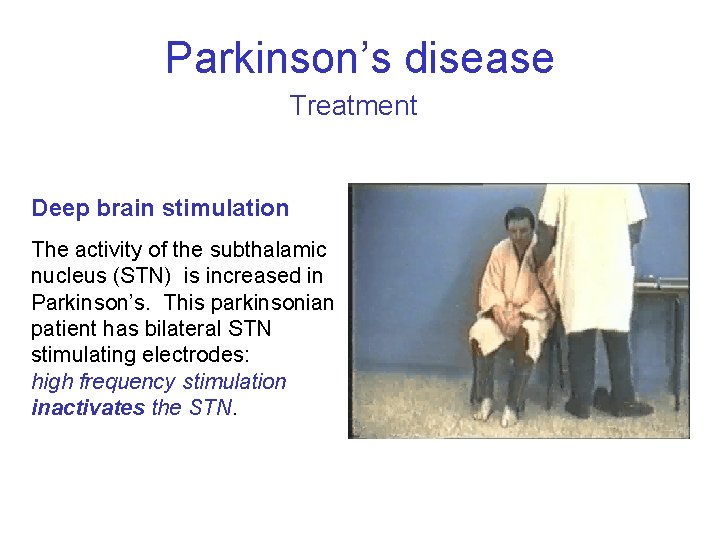 Parkinson’s disease Treatment Deep brain stimulation The activity of the subthalamic nucleus (STN) is