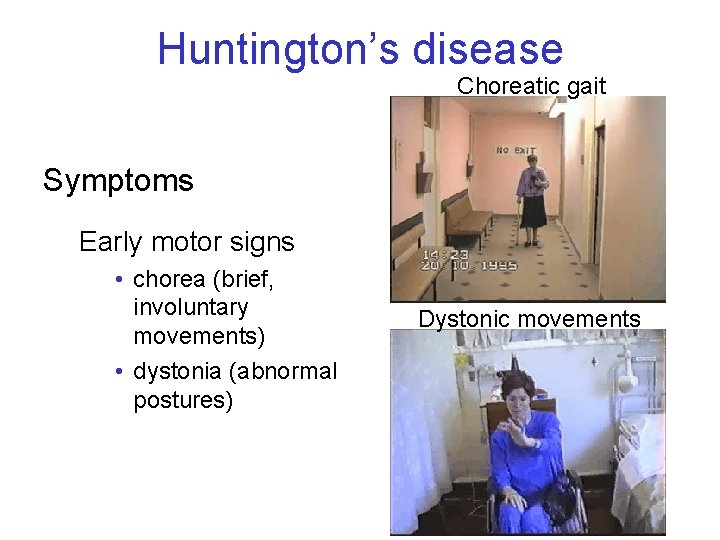 Huntington’s disease Choreatic gait Symptoms Early motor signs • chorea (brief, involuntary movements) •