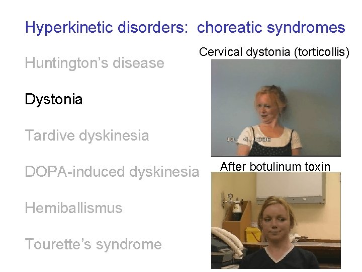 Hyperkinetic disorders: choreatic syndromes Huntington’s disease Cervical dystonia (torticollis) Dystonia Tardive dyskinesia DOPA-induced dyskinesia