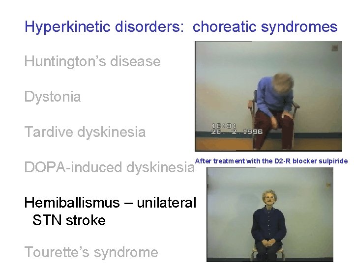 Hyperkinetic disorders: choreatic syndromes Huntington’s disease Dystonia Tardive dyskinesia After treatment with the D