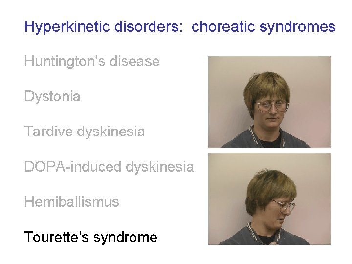 Hyperkinetic disorders: choreatic syndromes Huntington’s disease Dystonia Tardive dyskinesia DOPA-induced dyskinesia Hemiballismus Tourette’s syndrome