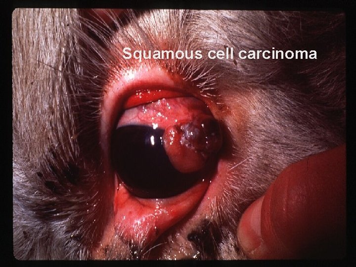 Squamous cell carcinoma 