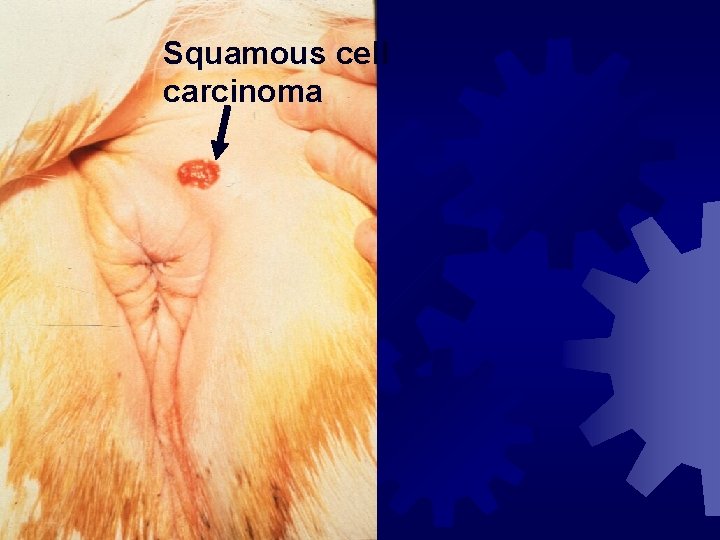 Squamous cell carcinoma 