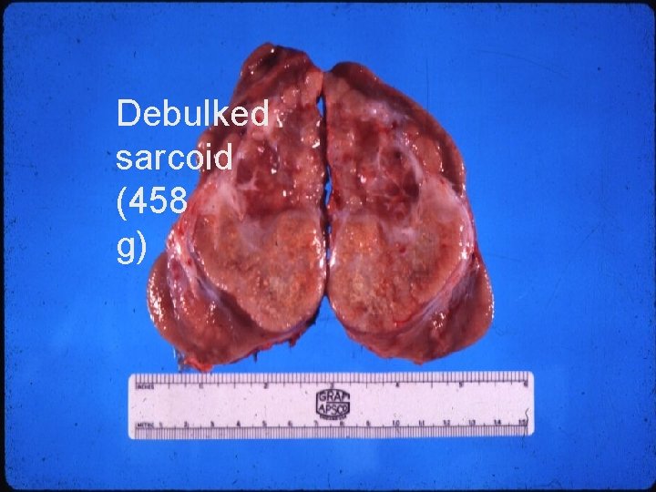 Debulked sarcoid (458 g) 