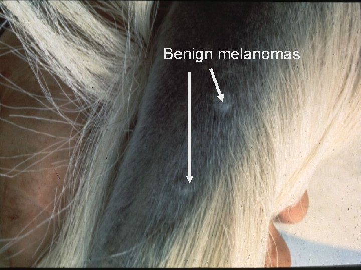 Benign melanomas 